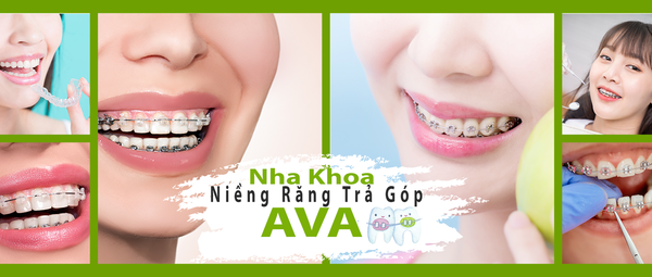 Niềng răng mắc cài kim loại - Nha Khoa AVA Dental - Blog